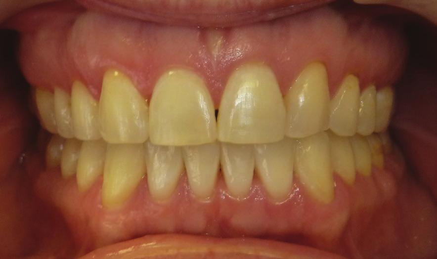 It appeared as if the overall smile was broader with this treatment. The nonextraction plan was accepted and we began treatment. IPR was performed in the lower arch and aligners were utilized.