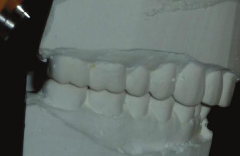 restoration. This patient presented after restoration of all upper teeth and lower molars.