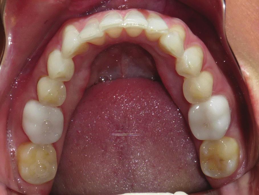 Without moving the upper incisors out of the way, there was no room for the lower crowding to unravel. Invisalign was proposed with IPR to gain room for the treatment and align the incisors.
