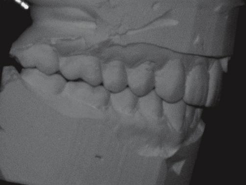 As of this writing, treatment has been going on for more than a year, and chipped incisor porcelain on the upper, space issues and a vague finish timeline have left the patient frustrated.