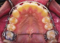 With the rest of the mandibular arch serving as a rigid anchorage unit, minimal side effects would be expected from the clockwise moment at the molar.