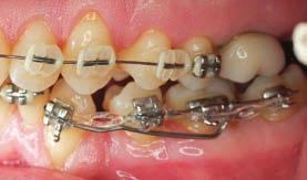 predictable force system was needed to upright the canine and minimize the duration of presurgical orthodontic treatment.