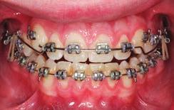 lthough anterior box elastics are often used for the correction of anterior open