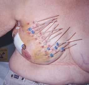Disadvantages Invasive Procedure Technically