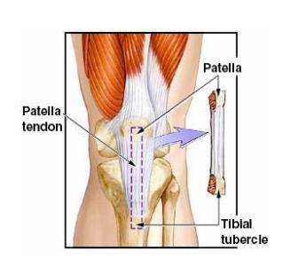 The pitfalls of the patellar tendon autograft are: Postoperative pain behind the kneecap Pain with kneeling Slightly increased risk of postoperative stiffness Low risk of patella fracture Allografts.