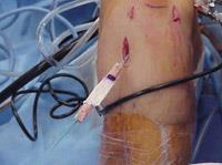 Surgical Procedure Passage of patellar tendon graft into tibial tunnel of knee.