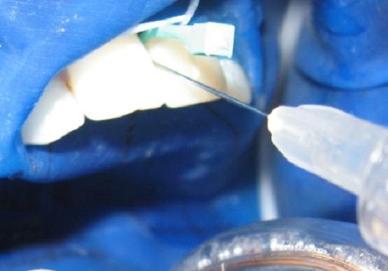 application of the infiltrant on the lesion for 3 minutes; the lamp of the dental unit will be turned off; removal of the infiltrant excess with prefabricated (denser) cotton
