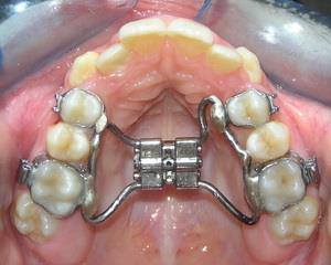 Rapid maxillary expansion What is
