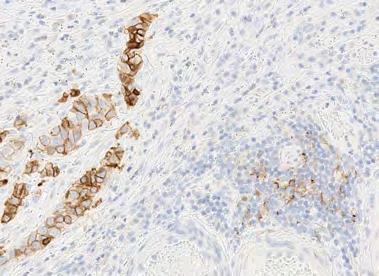 Tumor cells Immune cells Review PD-L1 stained slide at 10X or 20X to distinguish tumor cell and