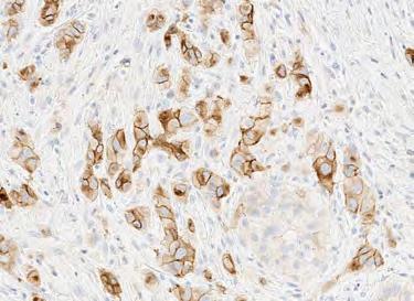 Review tumor cells at 10X or 20X to evaluate for membrane staining at any intensity.