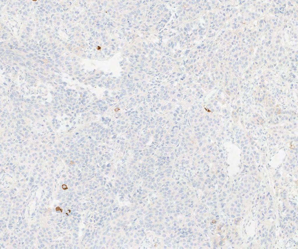 PD-L1 Expression Atlas in Urothelial Carcinoma