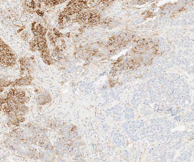 Tumor Cell Case 5: Tumor cells with 50% staining, Immune cells with 20% staining