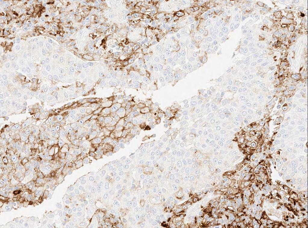 Challenging cases: Weak Tumor Membrane vs Cytoplasmic Staining