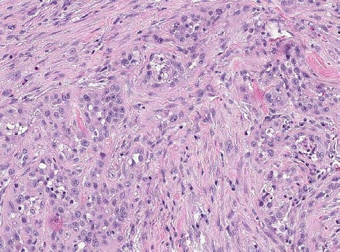 Challenging Case 2: Tumor cells with moderate or stronger membrane staining are readily