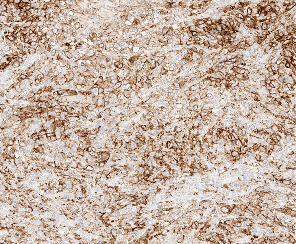 Challenging cases: Strong Immune Cell Staining Overlapping with Tumor