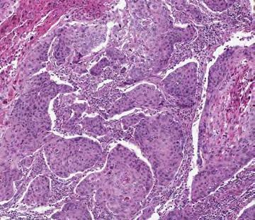 Clinical Evaluation Evaluating Staining Patterns and Intensities Urothelial carcinoma cases stained with the Assay