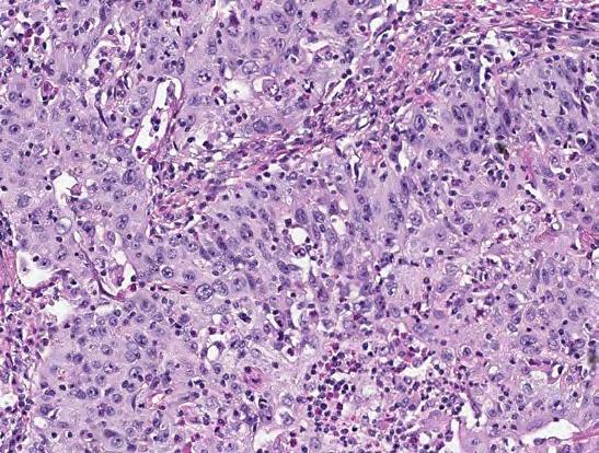 (20X)  Assay: Tumor cells show