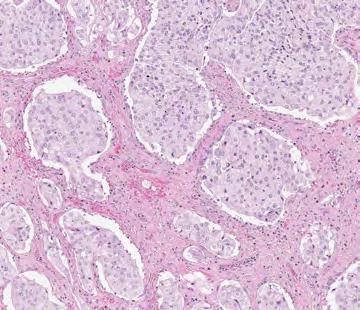 Tumor-Associated Immune Cell Staining: Immune cells exhibit a range of staining