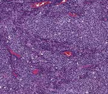 Immune cell staining is assessed by initially reviewing the entire tumor area and