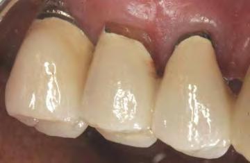 The result of removing this failing aged dentistry often leaves us with : Subgingival caries Subgingival margins Furcations Root flutes Root concavities Biologic width issues No attached tissue Fig 1.