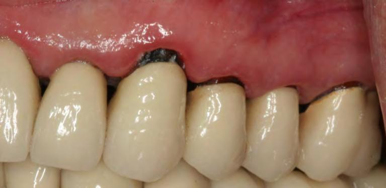 Fig. Pre-operative view of leaking existing crowns.