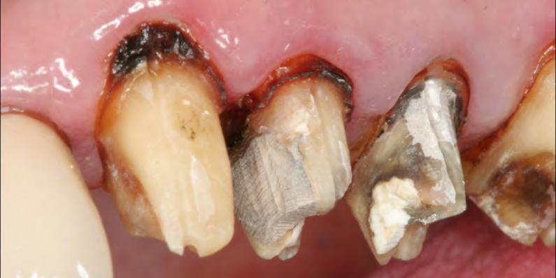 Occlusal view after removal of old crowns. Fig.