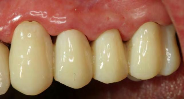 a contemplated restorative margin established. Fig. Occlusal view of adhesive cores.