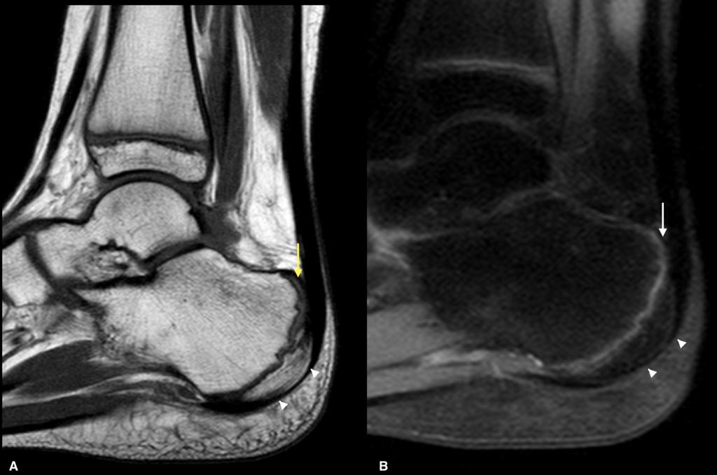 Fig. 11: Asymptomatic 11 years old boy. Calcaneal MRI, sagittal view. Shows the normal aspect of the calcaneal apophysis and physis.
