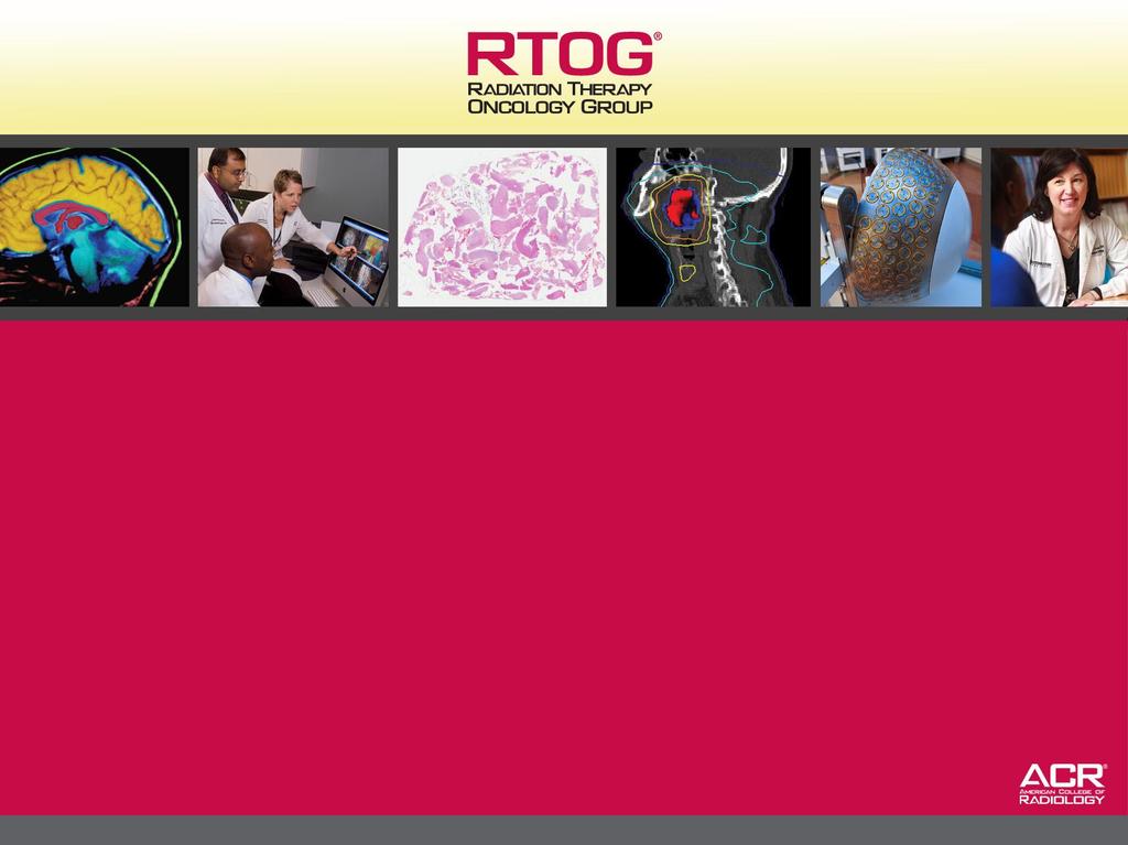 Chemotherapy plus Radiotherapy versus Radiotherapy Alone for Patients with Anaplastic Oligodendroglioma: Long Term Results of RTOG 9402 Gregory Cairncross, Meihua Wang, Edward Shaw,