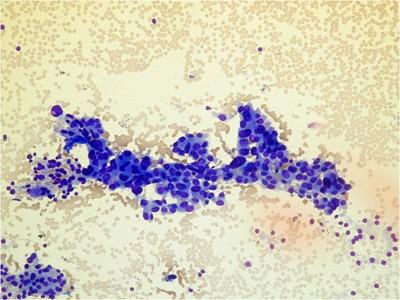 FNA result in our patient irregular sheets of abnormal cells, with crowded overlapping