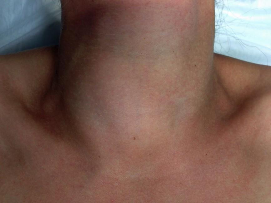 Solitary thyroid nodules incidence common age 30-50 years female : male 3 : 1 palpable 5%