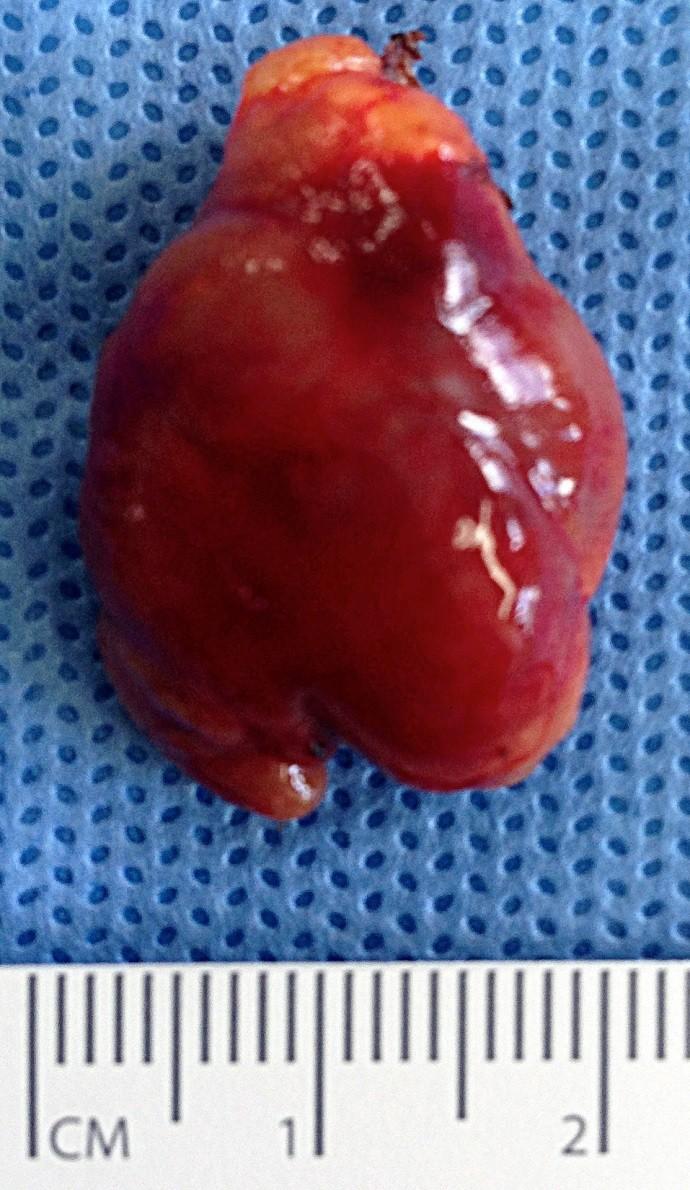 Focussed parathyroidectomy our patient localised on Mibi & US 2g parathyroid adenoma (N = 40-60mg) postop Ca 2+ 2.35, PTH 2.8 surgery in elderly?
