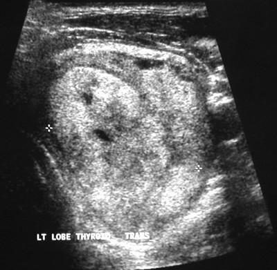 Ultrasound result There is large, 5cm irregular nodule replacing most of the left thyroid lobe,