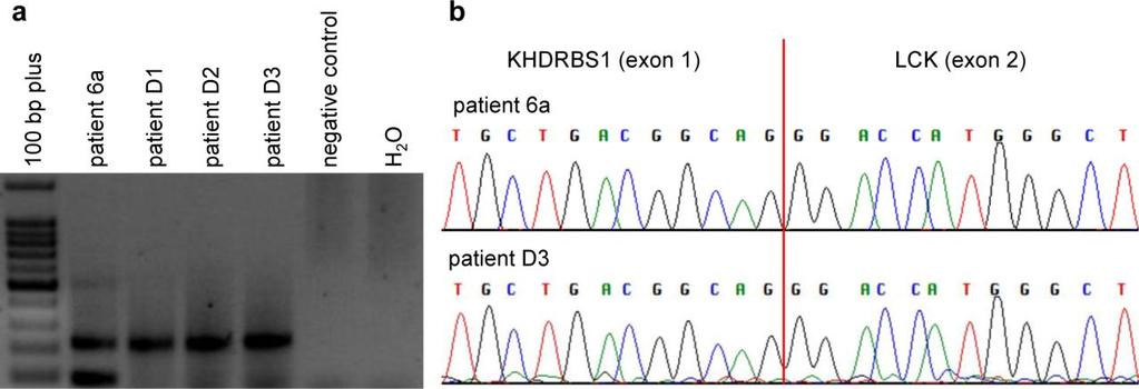 Supplementary Figure 5 Recurrent fusion of the genes KHDRBS1 and LCK in ALL. RNA was isolated from samples of a cohort of 74 unselected pediatric ALL and transcribed into cdna.