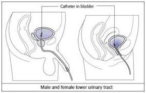 Key Terms Indwelling catheter: A drainage tube that is inserted into the urinary bladder through the urethra, is left in place, and is connected to a drainage bag (including leg bags).