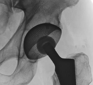 resorption of acetabular bone can be observed