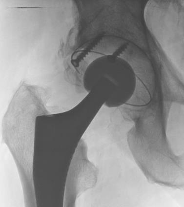 Complications (n=162) > intraoperative 1x fissure of femur 2x fissure of greater trochanter 1x cup tilted during reduction of hip revised next day and secured with screws > postoperative
