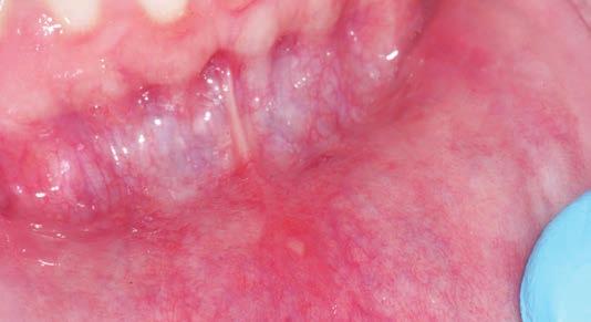 Recurrent Aphthous Stomatitis Recurrent Aphthous Stomatitis Oral lesions are quite common and practitioners frequently see both painless and painful varieties.