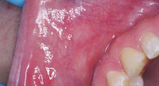 DENTAL LEARNING www.dentallearning.net Image courtesy of HIVDent Image courtesy of Klaus Peter Figure 2. Major recurrent aphthous stomatitis ulcerative lesion Figure 3.