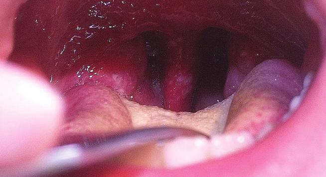 10 No matter what type of RAS a patient has, they are located on nonkeratinized mucosal tissues of the mouth.