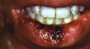 Recurrent Aphthous Stomatitis Image courtesy of HIVDent Figure 7. Herpes simplex virus lesion in HIV/AIDS patient is a detergent that provides the foaming action in oral health care products.