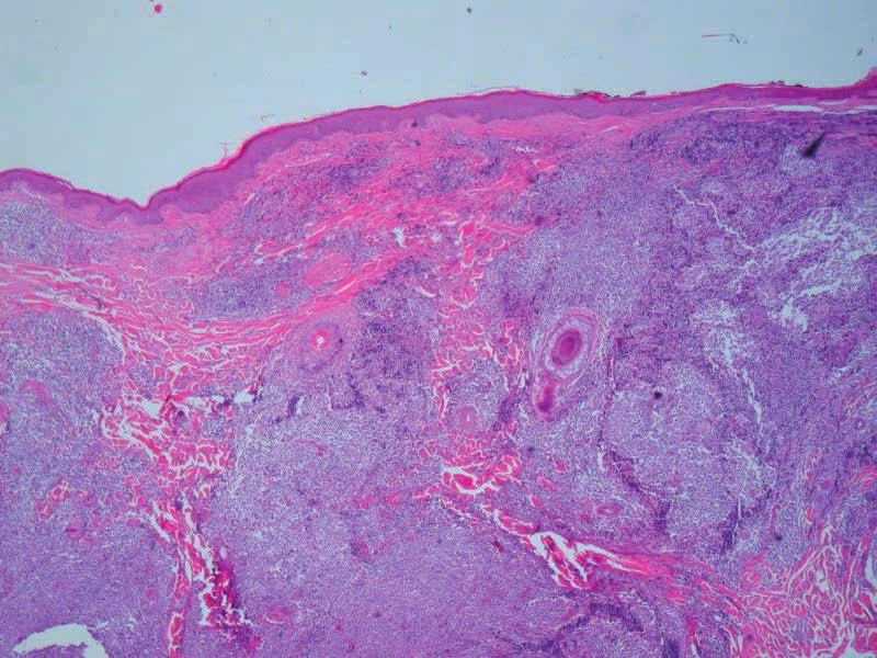IRREGULAR COLLAGENOUS FIBERS (PINK) AND FIBROBLAST NUCLEI (PURPLE); FROM THE DERMIS OF THE SKIN The question is no longer whether light has biological effects but rather how energy from therapeutic