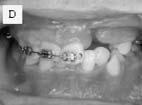 (Frontal view), D: Posttreatment (Occlusal