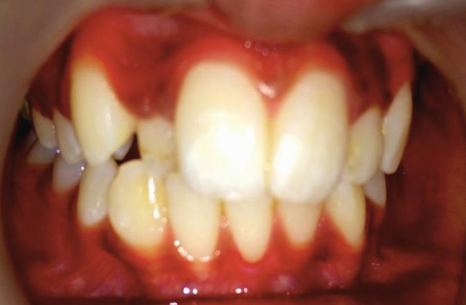 Crossbite may lead to abnormal enamel abrasion of lower incisor, thinning of labial alveolar plate with gingival recession, fracture of tooth, TMJ disturbances, periodontal pathosis (Valentine et al,