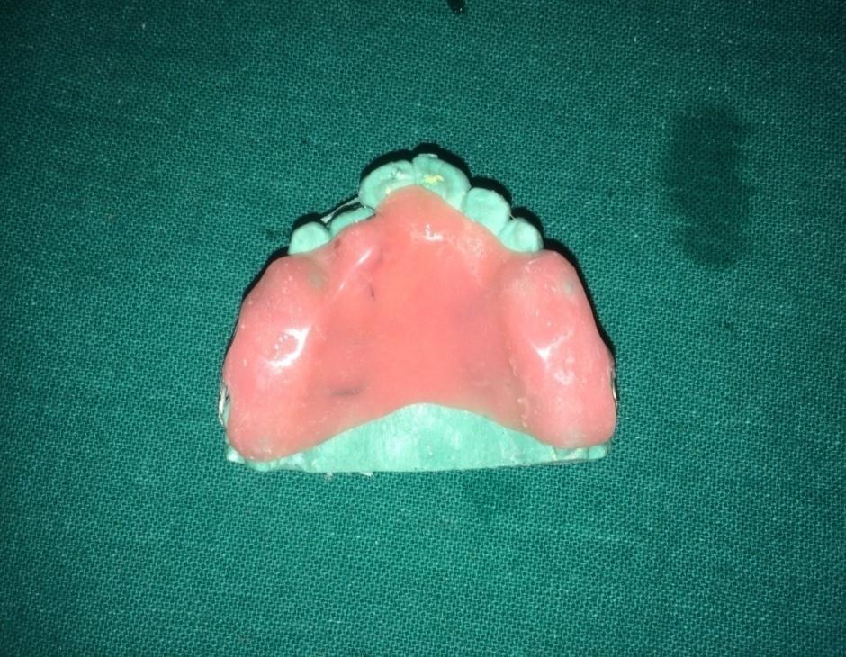 After crossbite correction, third aim was to bring all the maxillary teeth into the alignment.