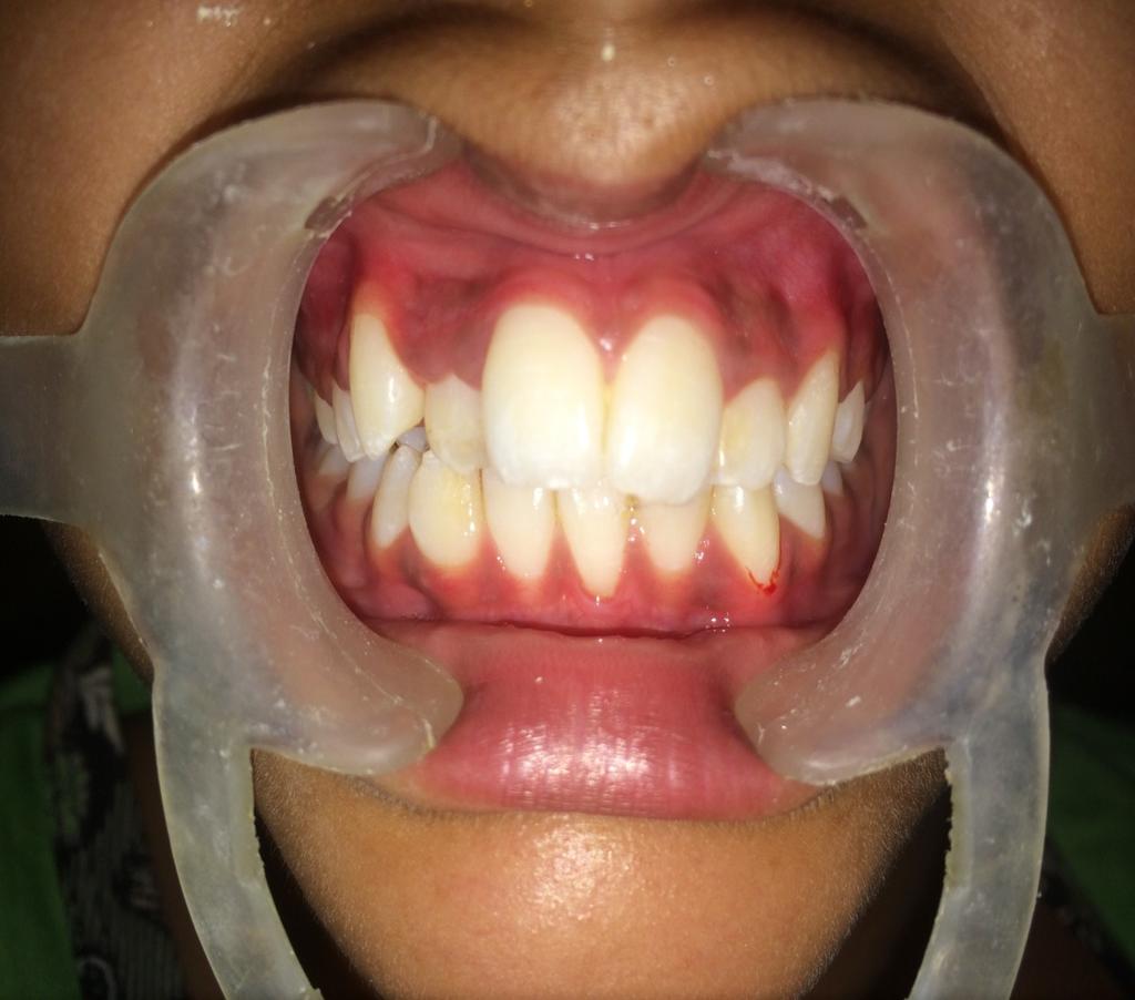 partial fixed appliance which was a 2 x 6 appliance. It engages both of the maxillary first permanent molars and central incisors, lateral incisors and canines.