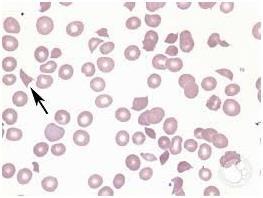 Thrombocytopenia Immune (idiopathic) Thrombocytopenic Purpura