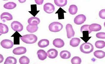Thrombocytopenia Thrombotic Thrombocytopenic Purpura