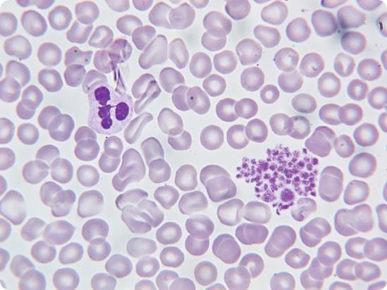 Malignancy Platelet Agglutination: Pseudothrombocytopenia