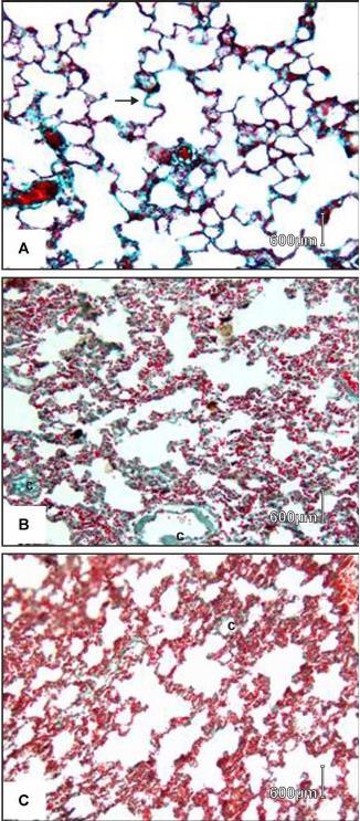 Fig.9. Photomicrographs of rat lung sections. (A) Normal control rat showing alveolar spaces and alveolar septum (arrow). (B) Bleomycin treated rat showing collapsed and narrow alveolar spaces.